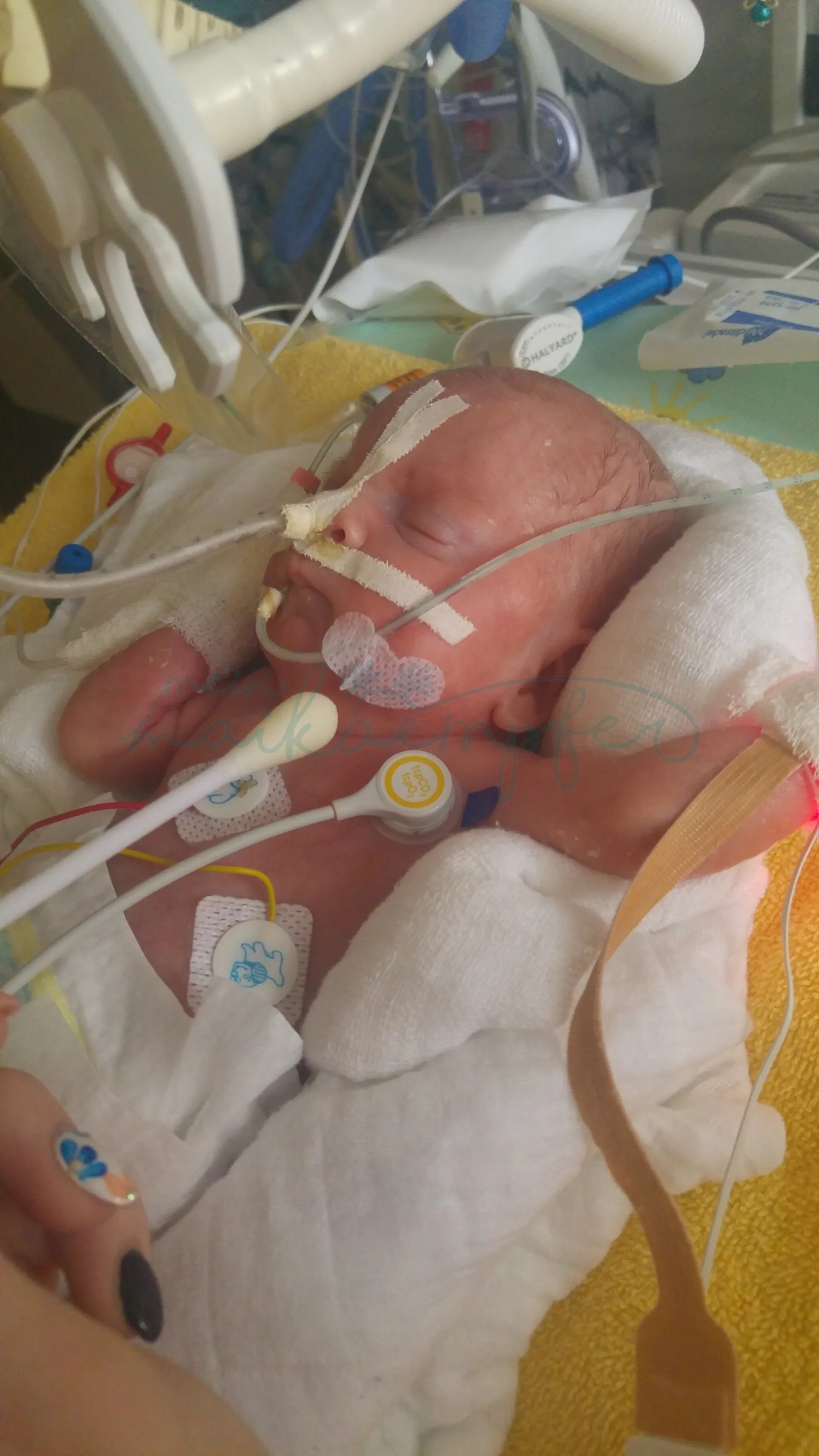 Raphael unser meinmaikaempfer® im Wärmebett, vollbeatmet und in Mullwindeln gebettet wird gerade durch eine Schwester versorgt