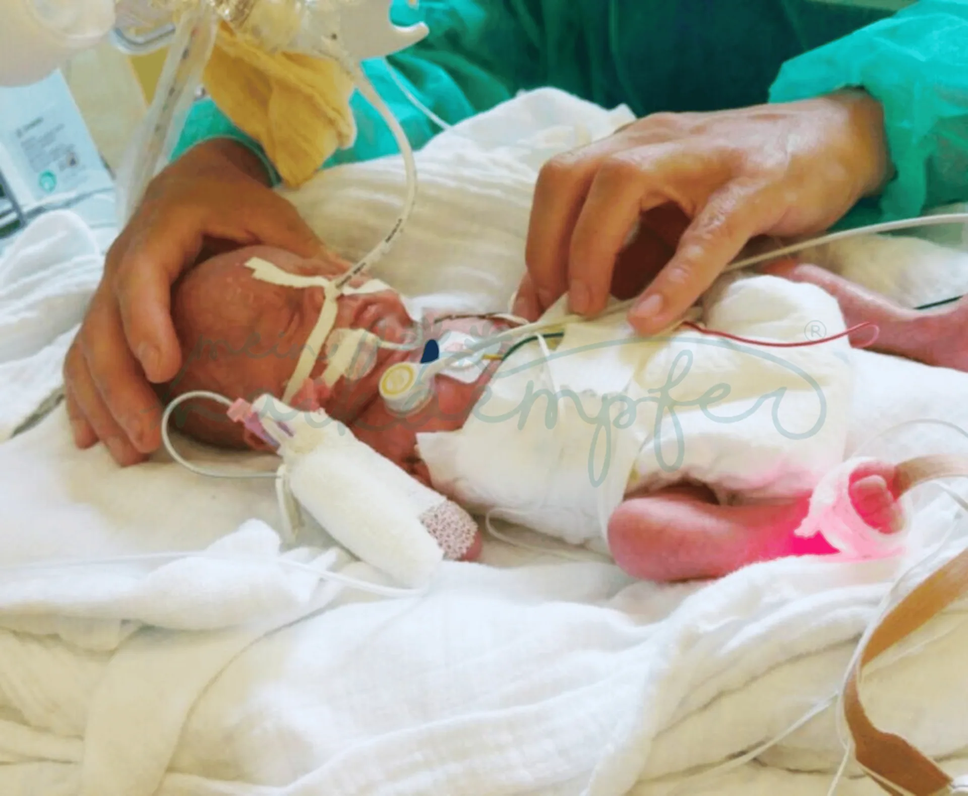 Raphael unser meinmaikaempfer® im Wärmebett, vollbeatmet und in Mullwindeln gebettet wird gerade durch eine Schwester versorgt